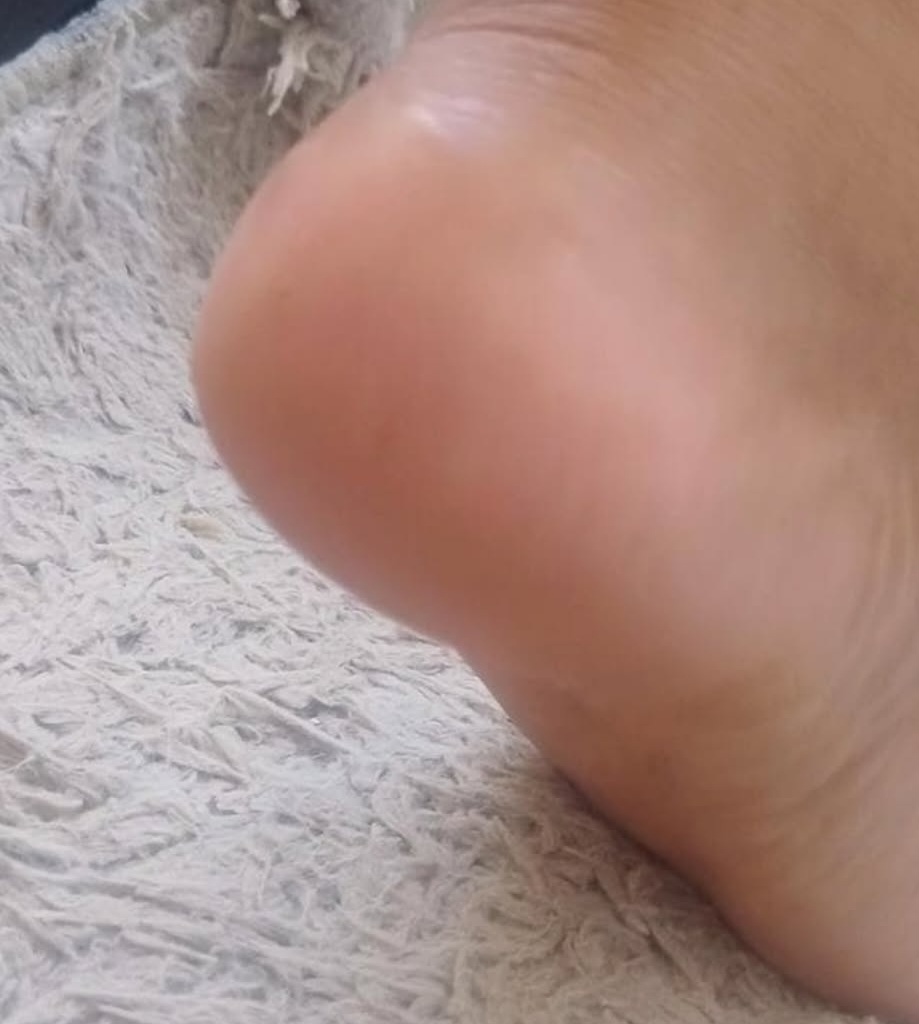 Imagem do serviço de Remoção de calosidade