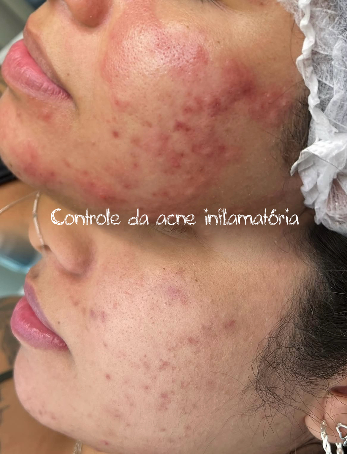 Protocolo acne off