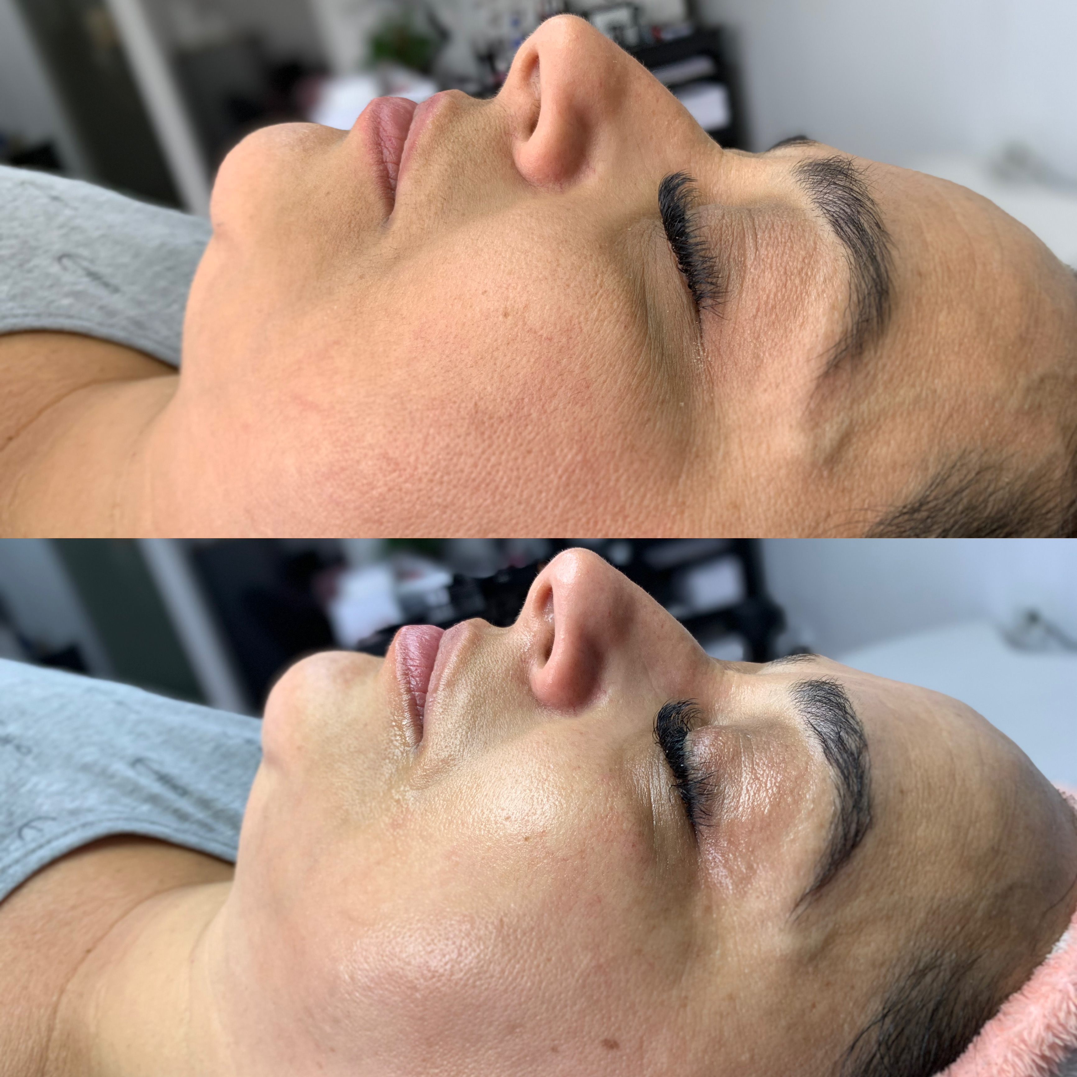 Imagem do serviço de Dermaplaning