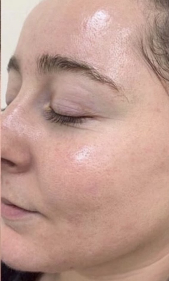 Imagem do serviço de Dermaplaning