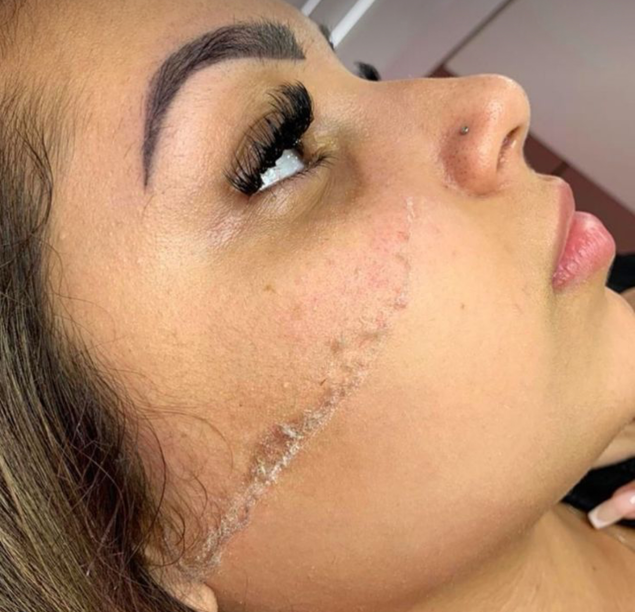 Imagem do serviço de Dermaplaning