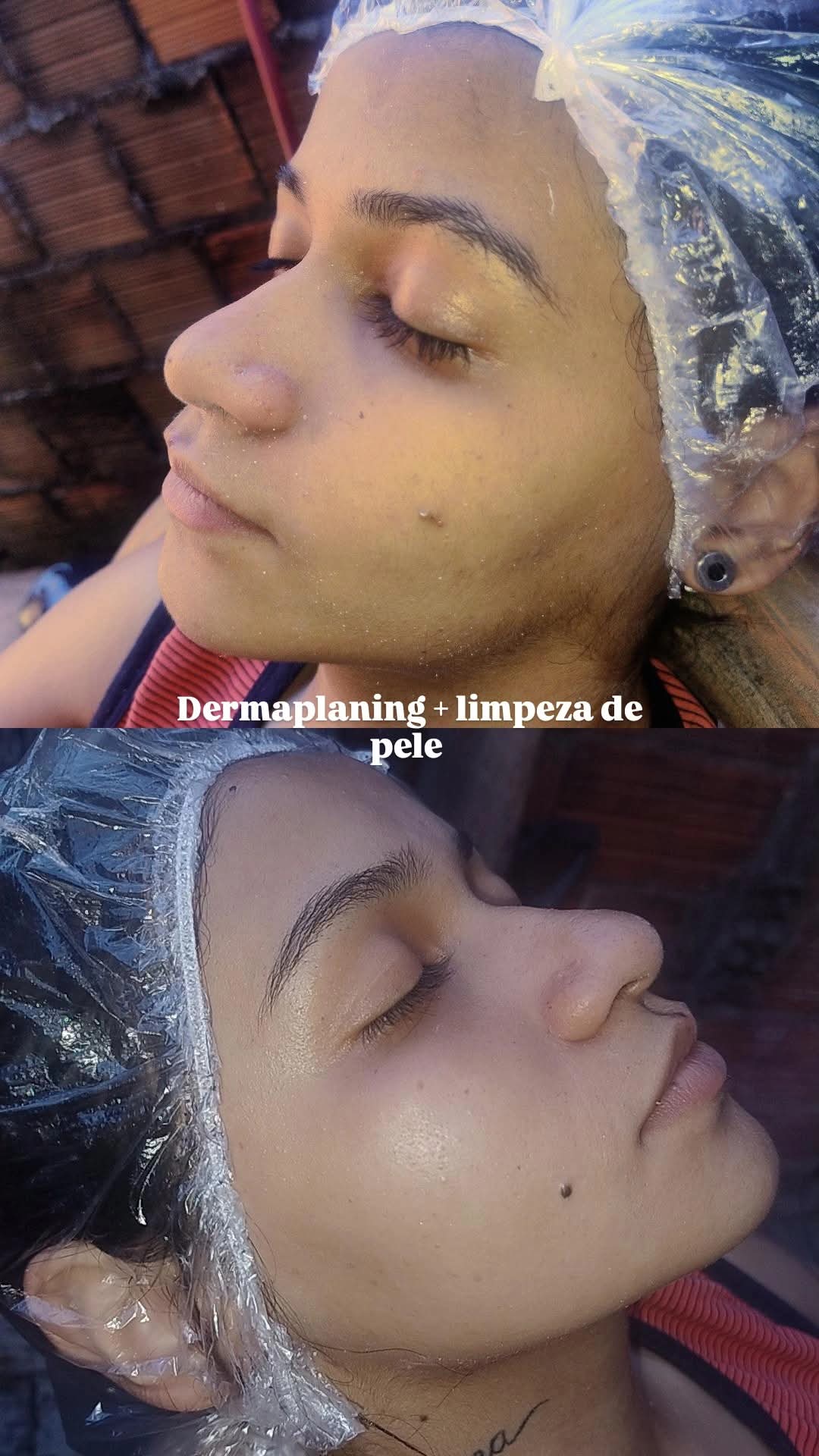 Imagem do serviço de Dermaplaning